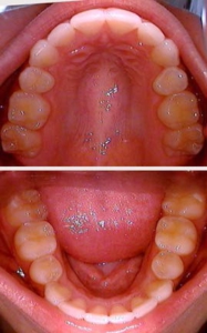Invisalign-after-109376